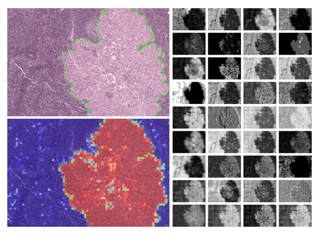 HE stained image of a breast cancer metastasis used by the machine learning model